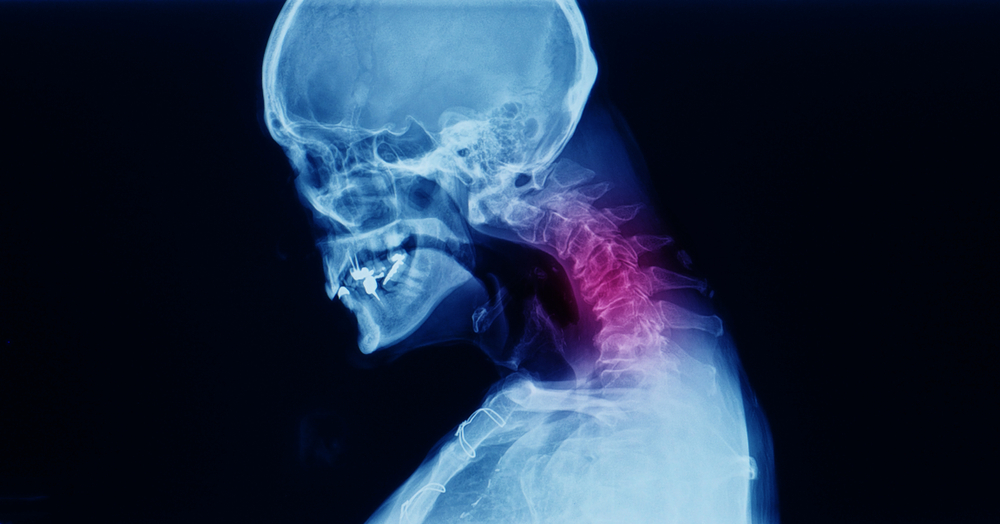 shutterstock 1424156117 showing the concept of Anterior Cervical Discectomy & Fusion