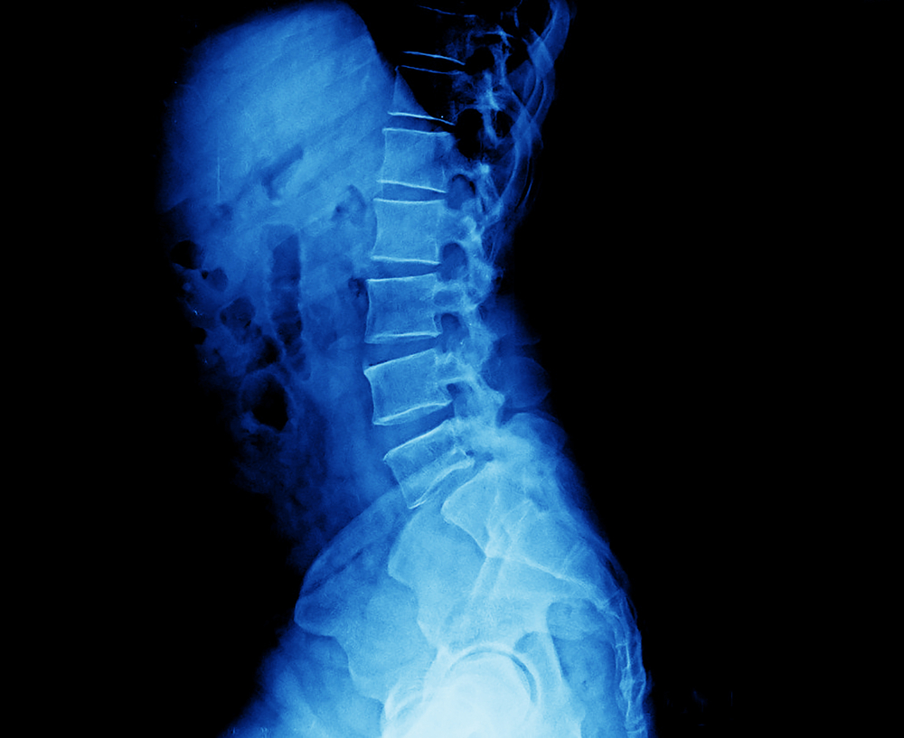 shutterstock 1774629482 showing the concept of Anterior lumbar interbody fusion (ALIF)