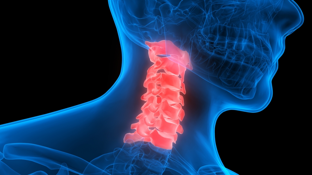 shutterstock 545238478 showing the concept of Cervical Corpectomy