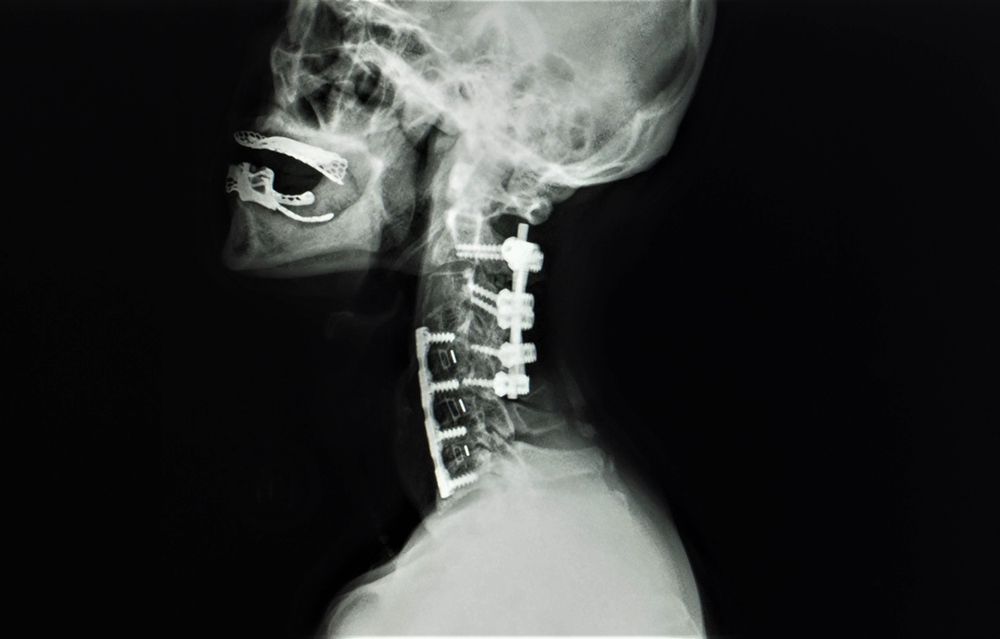 shutterstock 1324905086 showing the concept of Cervical Laminectomy