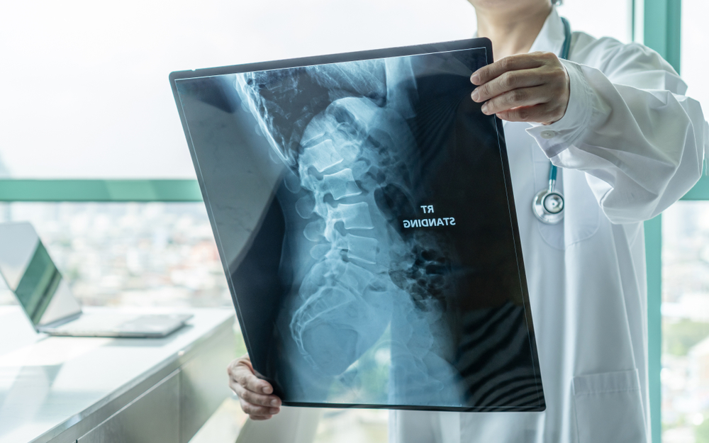 shutterstock 1536388574 1 showing the concept of Anterior and Posterior Scoliosis Surgery