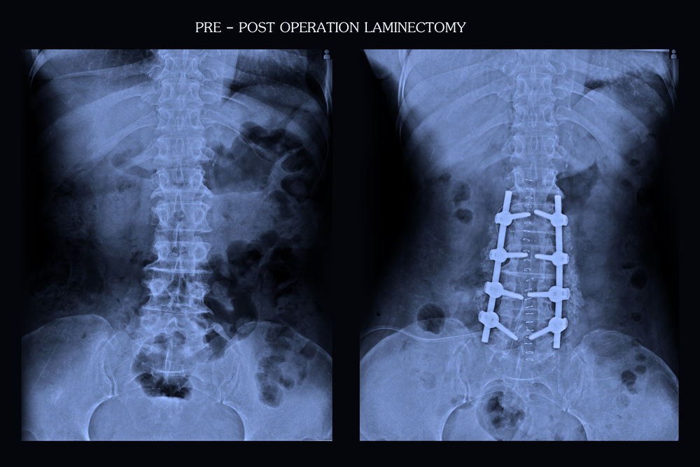 shutterstock 429811942 showing the concept of Posterior Lumbar Interbody Fusion (PLIF)