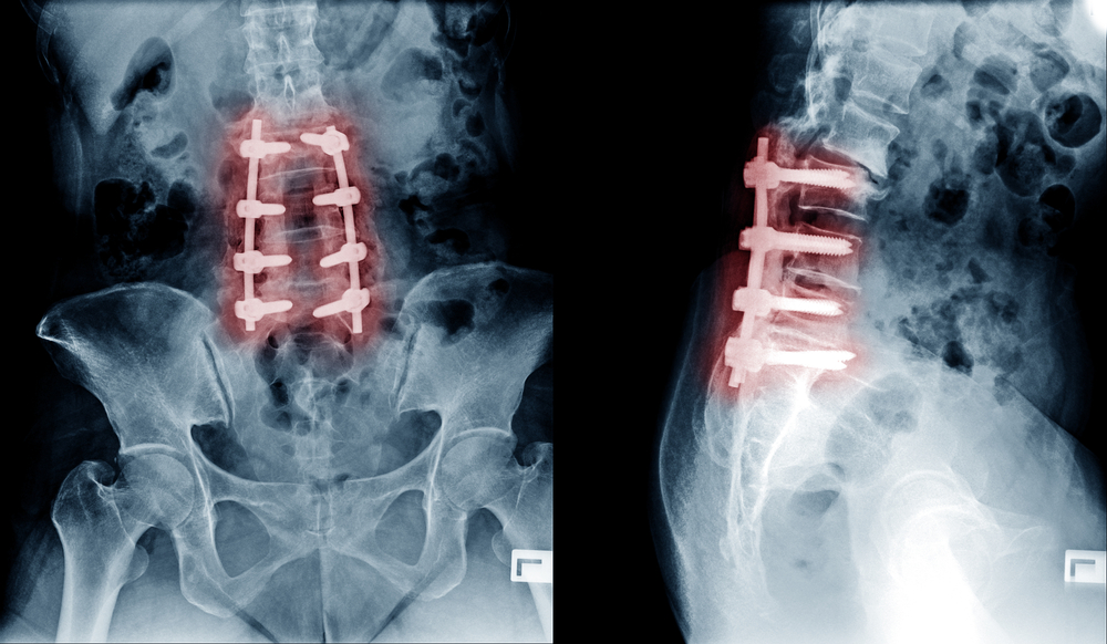 shutterstock 545456884 showing the concept of Spinal Fusion